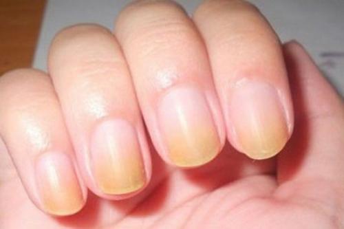 Что делать, если ногти пожелтели