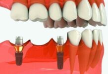 Корейские дентальные имплантаты: плюсы и минусы применения