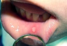 Повреждения слизистой