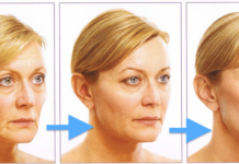 Технологии операций подтяжки лица