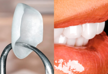 Как ставят виниры?