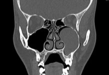 КТ околоносовых пазух: что показывает и где сделать процедуру