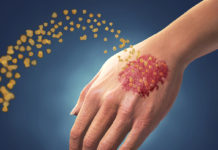 Современные методы лечения псориаза