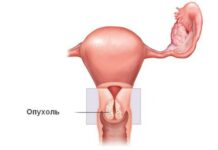 Методы лечения рака шейки матки
