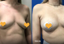 Виды женской груди и маммопластика