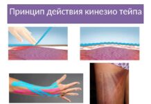 Кинезио тейп: принцип действия