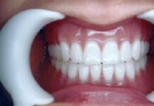 Съемные протезы при отсутствии зубов