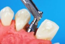 Зубная паста Bluem: предотвращает воспаление десен и ускоряет их восстановление после вживления имплантата