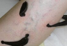 Применение гирудотерапии при климаксе