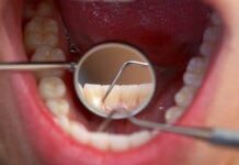 Методики профилактики кариозных поражений