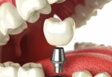 В чем заключается суть имплантации зубов?