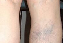 Венозная недостаточность