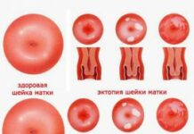 Что такое эрозия шейки матки и как ее лечить?