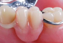 Протезирование зубов: виды, сроки и рекомендации