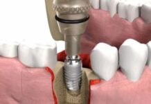 Этапы имплантации зубов