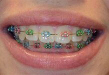 Современные брекеты: какие бывают, зачем нужны