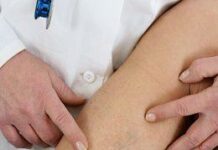 Лечение варикоза вен