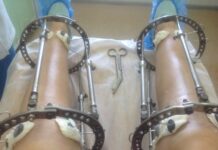 Удлинение ног – новое сумасшествие пластической хирургии