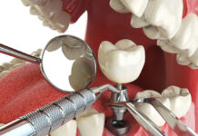 Имплантация зубов: преимущества, основные этапы