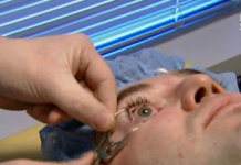 Как проводится лазерная коррекция зрения?