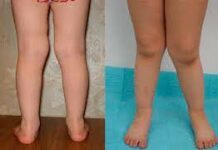 Как исправить Х-образную деформацию ног у ребенка?