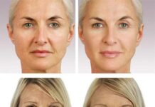 Филлеры для контурной пластики лица