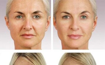 Филлеры для контурной пластики лица