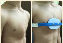 Как исправить килевидную деформацию грудной клетки?