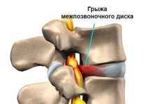 Когда грыжу межпозвонкового диска надо оперировать?