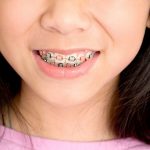 В каком возрасте ставят брекеты детям?