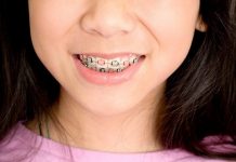 В каком возрасте ставят брекеты детям?