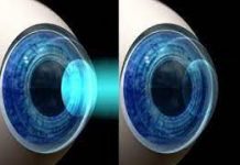 Что такое ФРК в офтальмологии