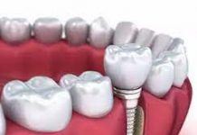 Как правильно выбрать зубные импланты?