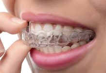 Что такое элайнеры?