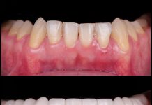 Обновление улыбки: процесс исцеления прикуса в клинике Вэнстом