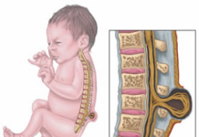 Особенности помощи детям с диагнозом Спина бифида в Израиле