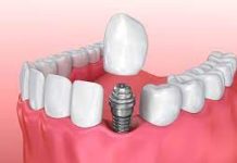 Классическая имплантация зубов: восстановление утраченной улыбки с помощью современной технологии