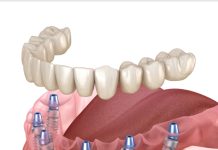 Имплантация зубов: все на 6
