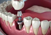 Преимущества и недостатки имплантации зубов по сравнению с другими методами