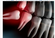 Сложное удаление зуба: когда это необходимо и что следует знать