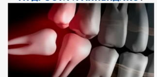 Сложное удаление зуба: когда это необходимо и что следует знать