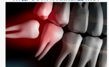 Сложное удаление зуба: когда это необходимо и что следует знать