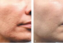 Омоложение кожи с помощью Морфеус 8: микроигольчатый RF-лифтинг