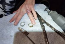 Спасатели помогли пензенцу избавиться от двух колец на пальце