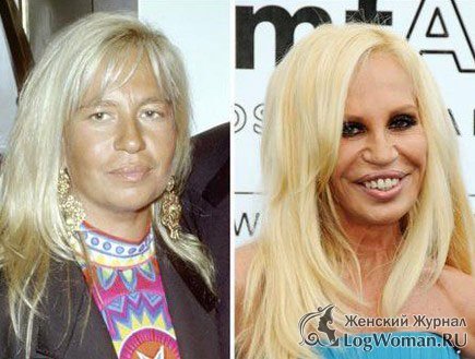 Звёзды До и После пластической операции Звёзды До и После пластической операции