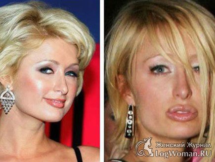 Звёзды До и После пластической операции Звёзды До и После пластической операции