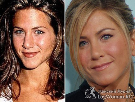 Звёзды До и После пластической операции Звёзды До и После пластической операции
