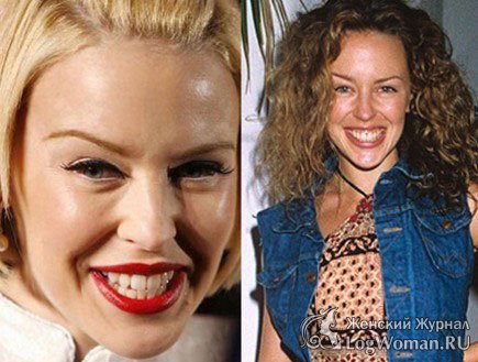 Звёзды До и После пластической операции Звёзды До и После пластической операции