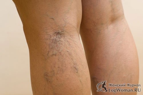 Как предотвратить варикозное расширение вен Как предотвратить варикозное расширение вен