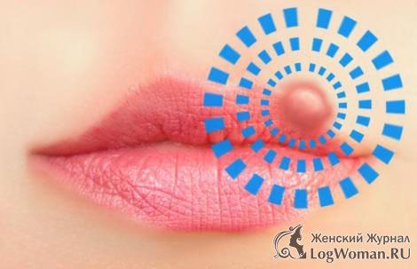 Заморозка герпеса